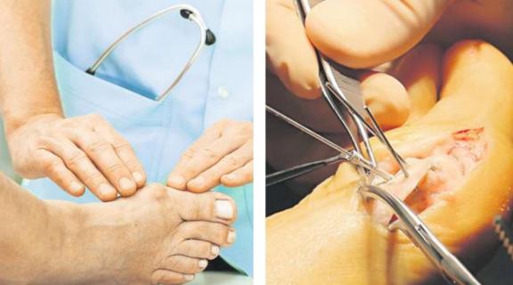 Für schmerzhafte Deformationen wie zum Beispiel der Hallux Valgus (links) ist die neue Operationsmethode mit der Magnesiumschraube ein großer Fortschritt. FOTOS: CP, MARIEN-KRANKENHAUS Für schmerzhafte Deformationen wie zum Beispiel der Hallux Valgus (links) ist die neue Operationsmethode mit der Magnesiumschraube ein großer Fortschritt. FOTOS: CP, MARIEN-KRANKENHAUS